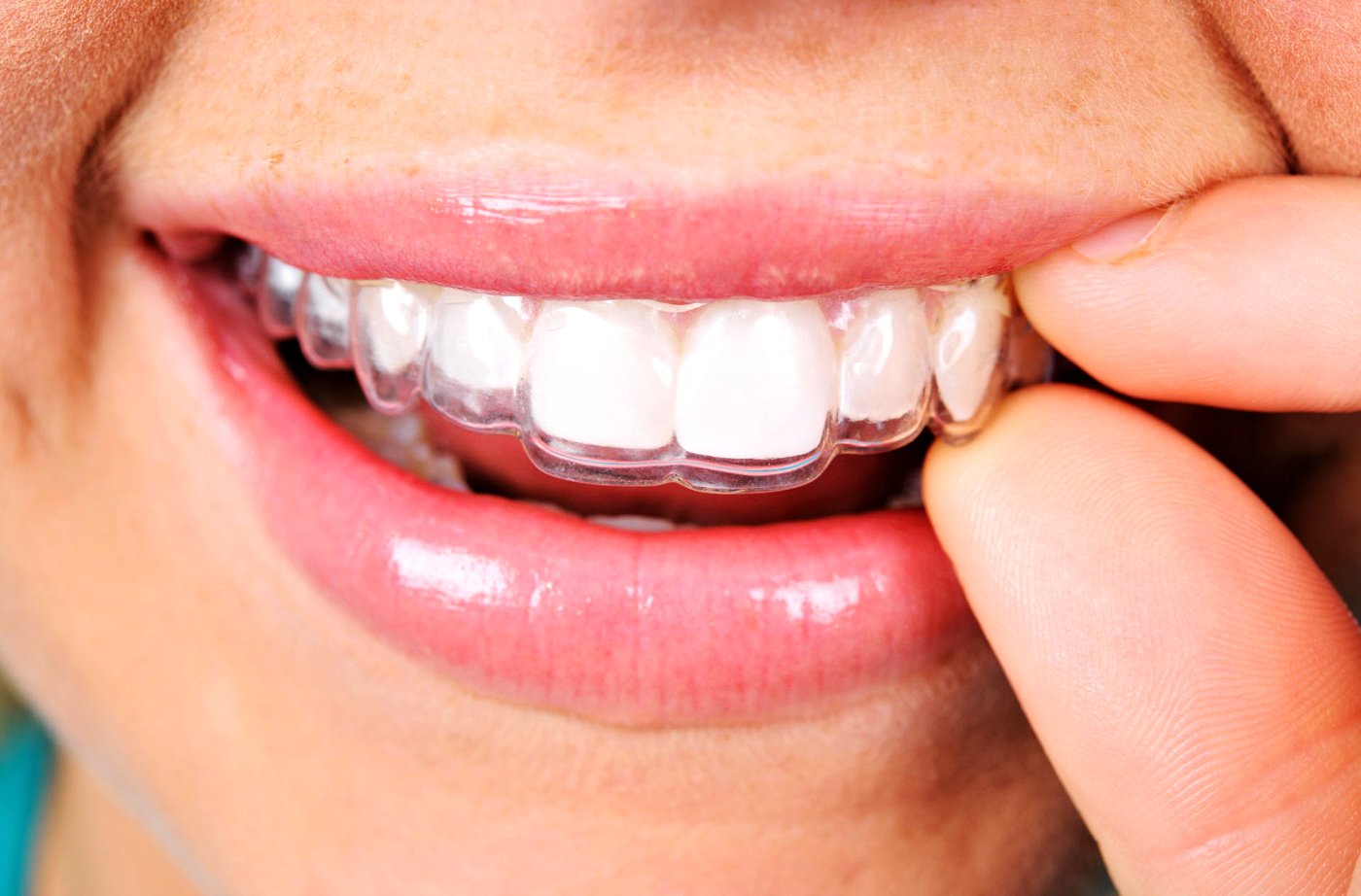 Fitting a clear aligner