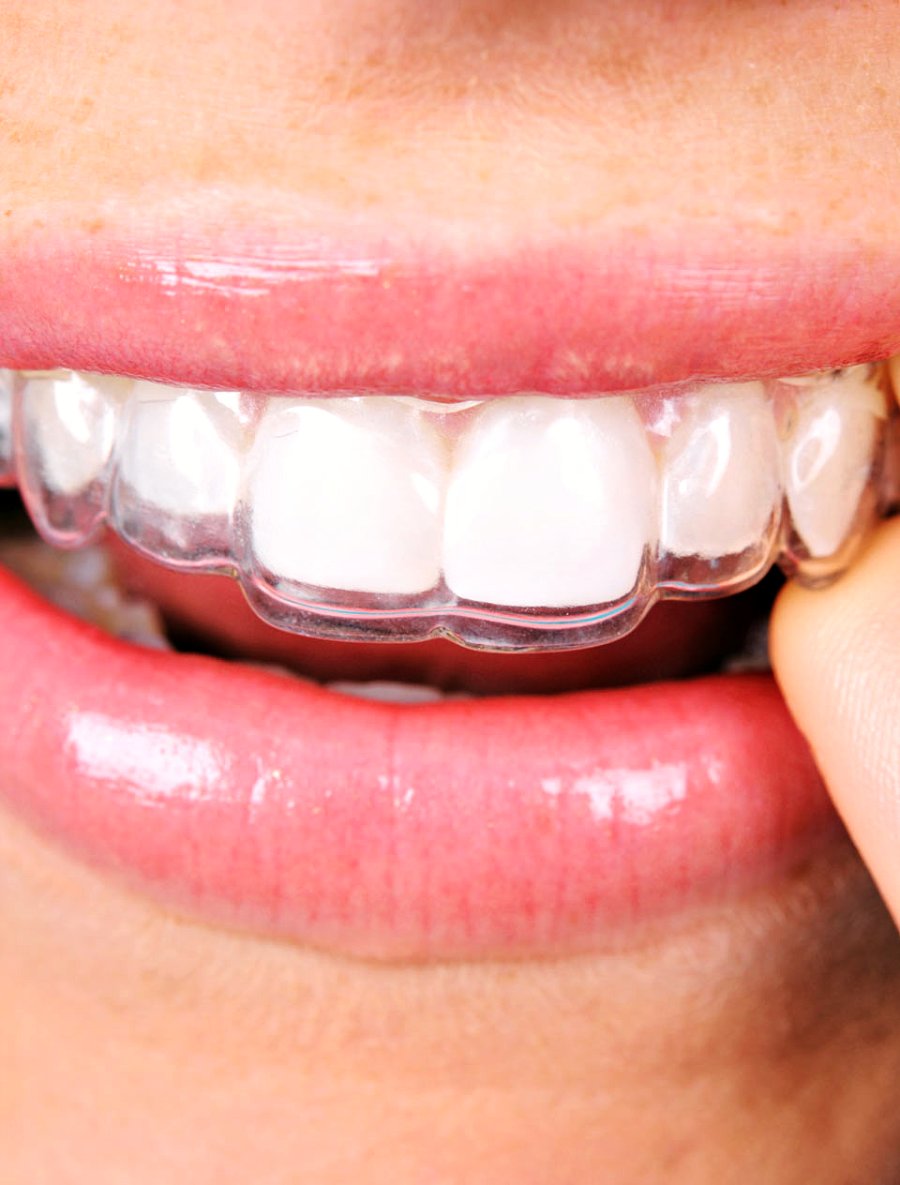 A smile with a clear aligner
